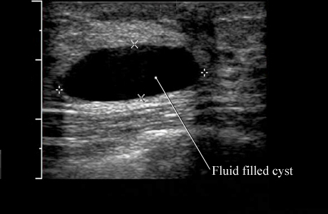 Image of a simple breast cyst