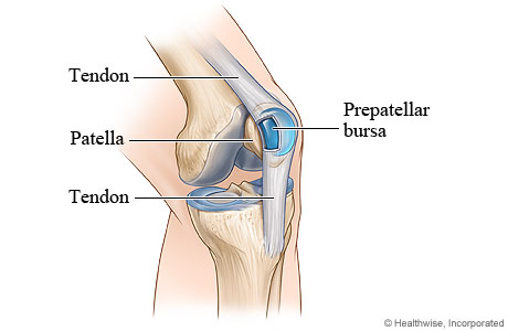 Bursitis of the knee