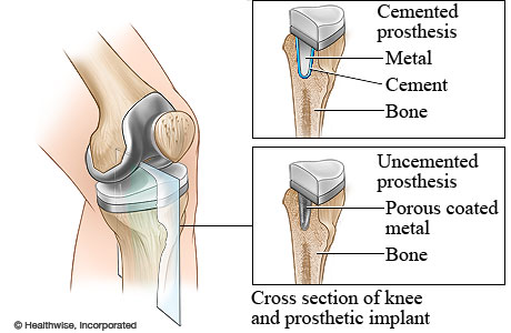 Cemented and uncemented prosthetics